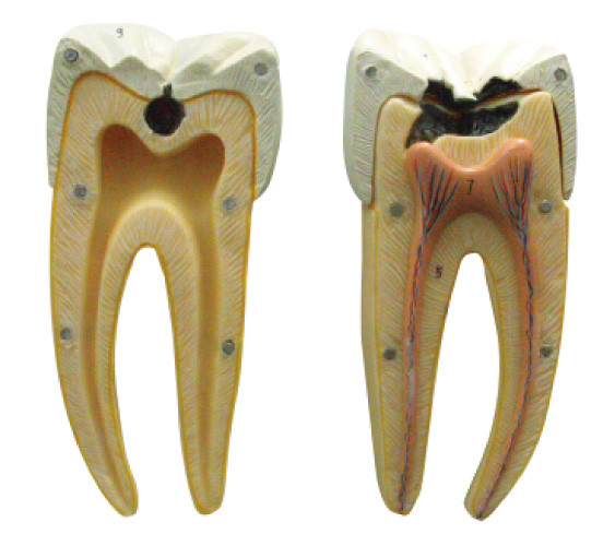 Στα αρχικά και προχωρημένα στάδια του προτύπου οδοντικών τερηδόνων για την εκμάθηση και την κατάρτιση