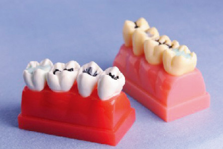 Ανθρώπινο πρότυπο δοντιών για το πρότυπο επίδειξης στεγανωτικής ουσίας και Inlay 4 φορές Lifesize