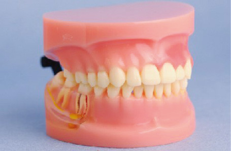 Πρότυπο του περιοδοντικού προτύπου δοντιών ασθενειών ανθρώπινου για τα ιατρικά κολλέγια και την κατάρτιση κλινικών