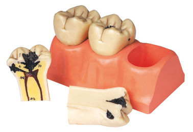 Τεμαχισμένο ανθρώπινο πρότυπο δοντιών της οδοντικής ασθένειας για το οικοτροφείο και την κατάρτιση σπουδαστών